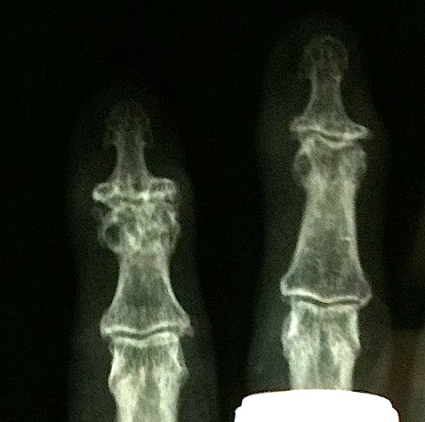 DIPJ Osteoarthritis